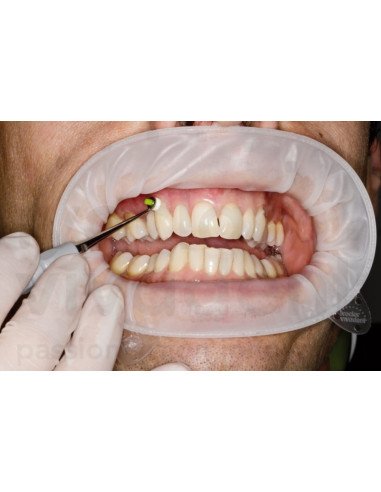 OptraGate Ivoclar