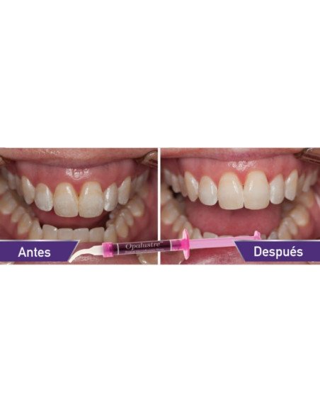 Opalustre Ultradent
